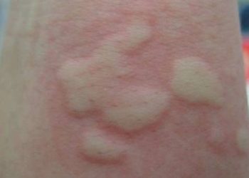 5 Cara Mencegah Terjadinya Alergi Dingin