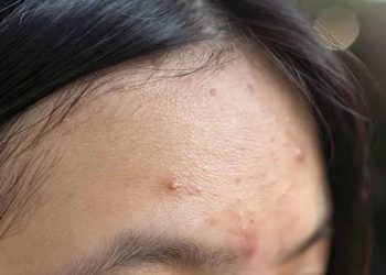 Wajah Bruntusan? Tenang Ini Cara Mengatasinya