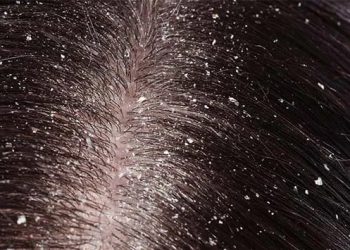 Ternyata Stres Dapat Menimbulkan Ketombe, Simak 5 Pencegahan Berikut