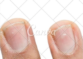 Bintik Putih Pada Kuku Bukan Pertanda ada yang Naksir! Yuk, Cek Faktanya!