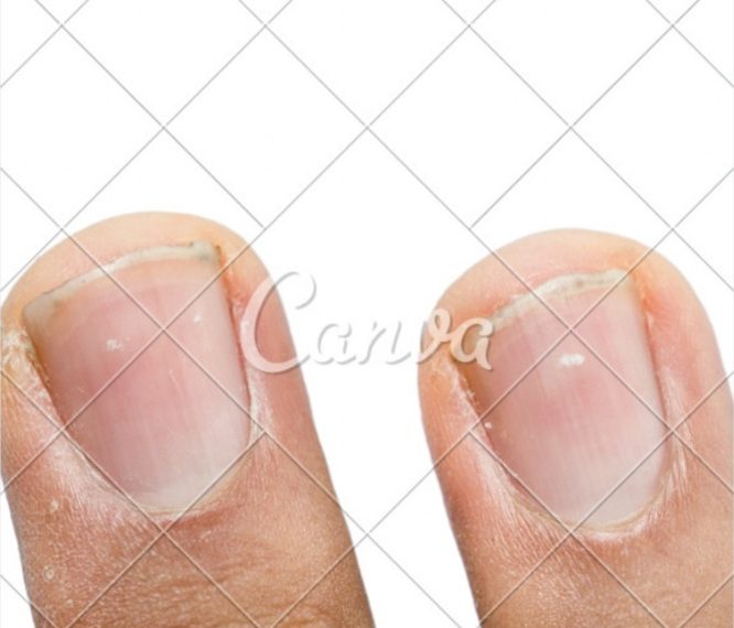 Bintik Putih Pada Kuku Bukan Pertanda ada yang Naksir! Yuk, Cek Faktanya!