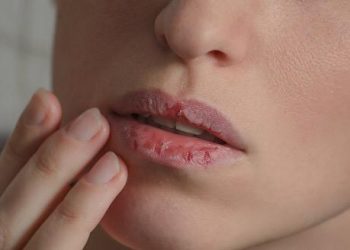 Bibir Kering Bikin Tak Percaya Diri, Berikut 4 Tips Aman Mengatasinya