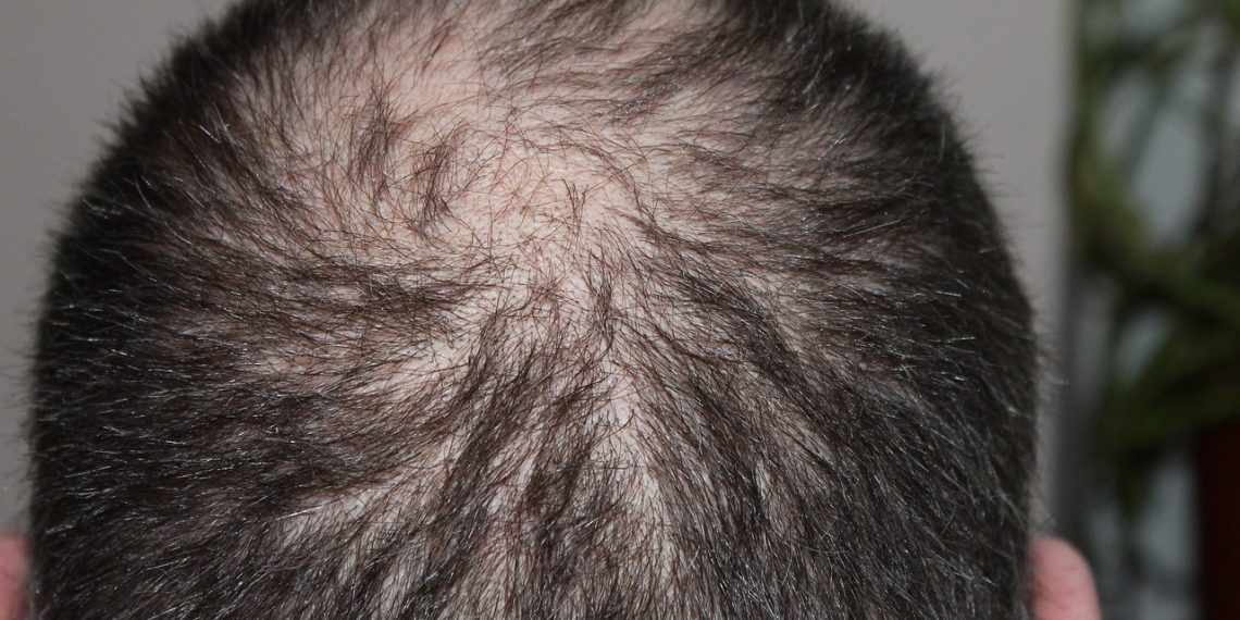 Vitamin yang dapat Menyembuhkan Kerontokan Rambut