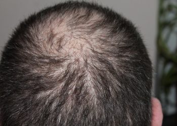 Vitamin yang dapat Menyembuhkan Kerontokan Rambut